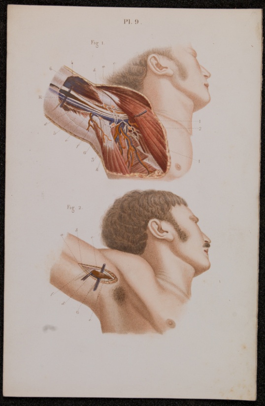 Claude Bernard and Charles Huette. A text book of operative surgery and surgical anatomy. Translated from the French and edited by Arthur Trehern Norton. London,1878.